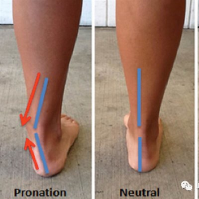 矫形鞋垫不就是足弓支撑吗？